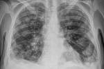 X-ray of lungs with metastases.