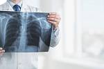 According to experts, up to 450,000 individuals in the Czech Republic may be living with an as yet undiagnosed chronic obstructive pulmonary disease.